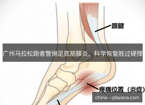 广州马拉松跑者警惕足底筋膜炎，科学恢复胜过硬撑